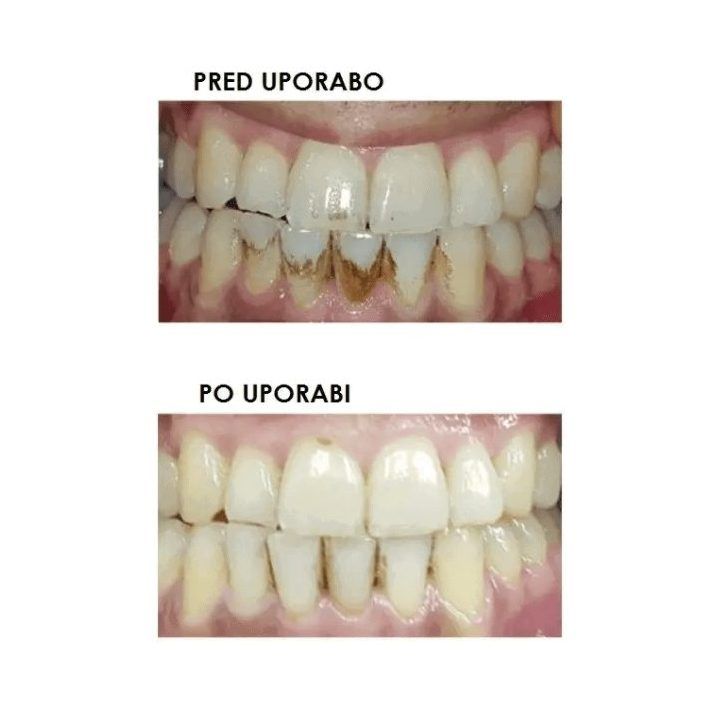 Elektrinis dantų šepetėlis su DentalRF technologija Silkn ToothWave